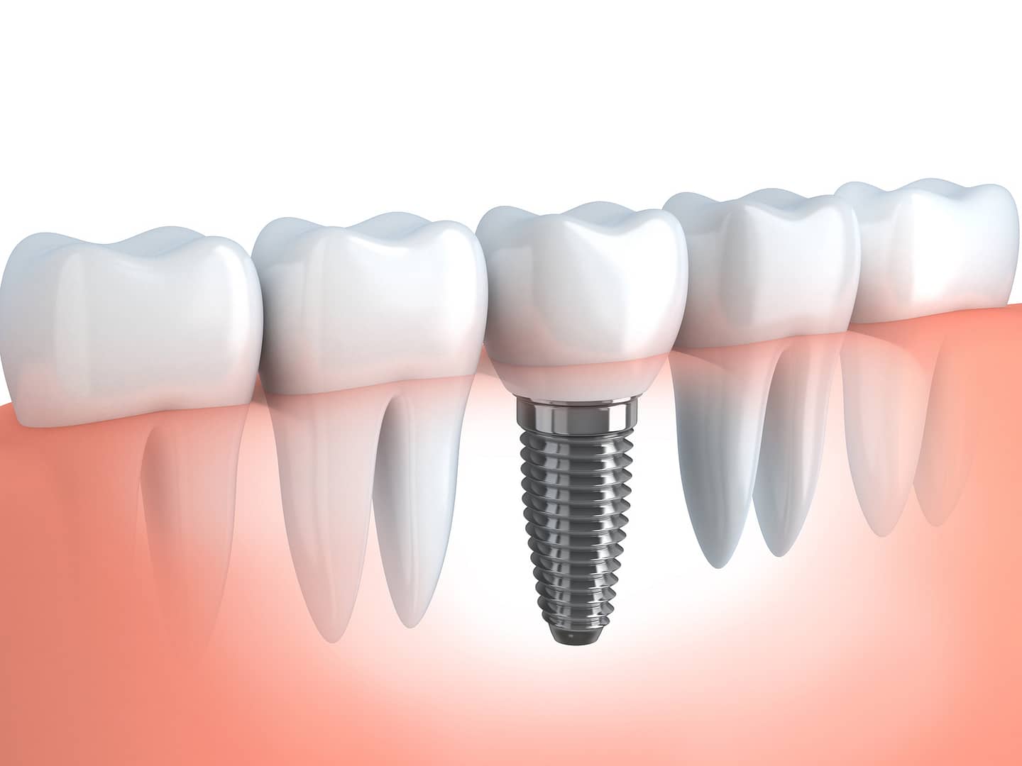 Dents artificielles et prothèses implantaires en 24-48 heures - Heraeus